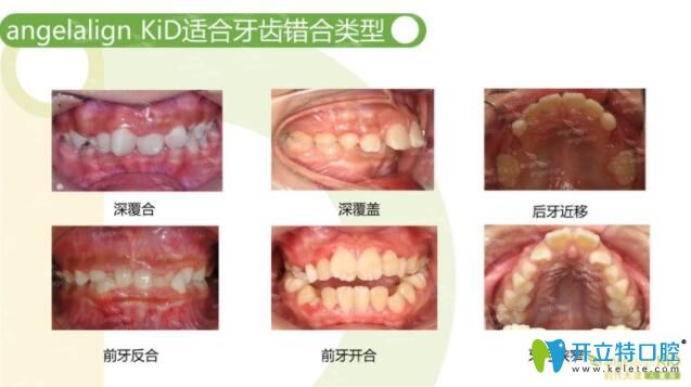 時代天使隱形矯正兒童版的適應(yīng)癥