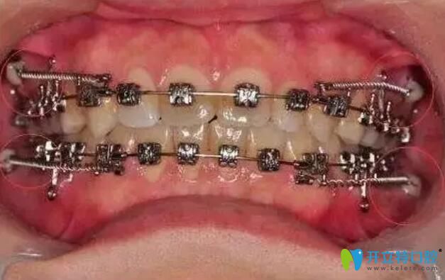 牙齒矯正支抗釘要打幾個(gè)