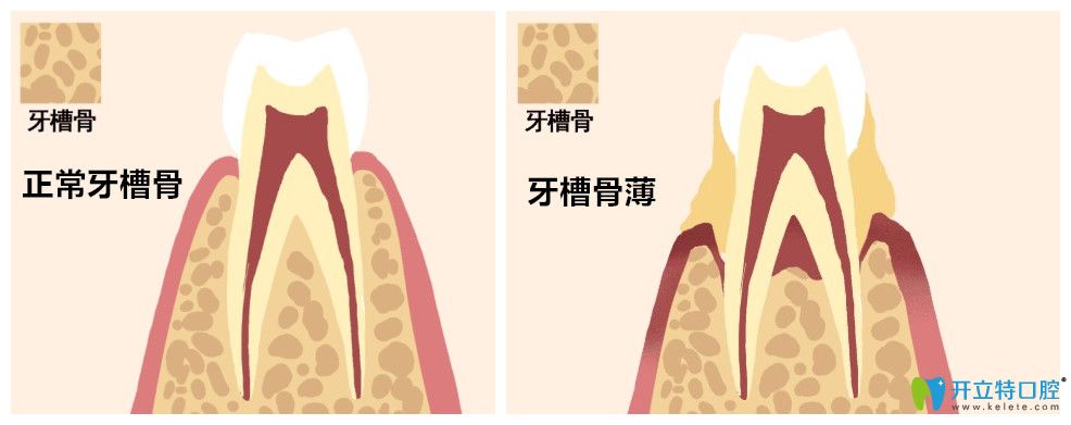 什么是牙周翻瓣植骨手術