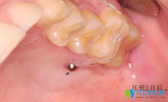 支抗釘壓低2個(gè)月后