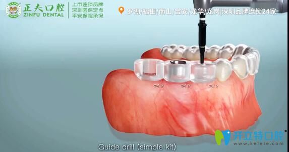 3d導(dǎo)板<span style=