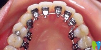 深圳珮斐齒科秦瑞玲介紹舌側(cè)隱形矯正技術(shù)優(yōu)勢(shì)