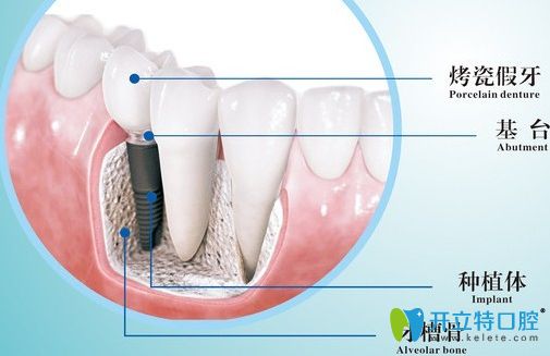 種植牙結(jié)構(gòu)分布
