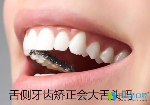 做舌側(cè)牙齒矯正會(huì)大舌頭嗎