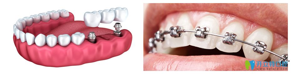 種植牙和牙齒矯正圖片 種植牙和牙齒矯正圖片