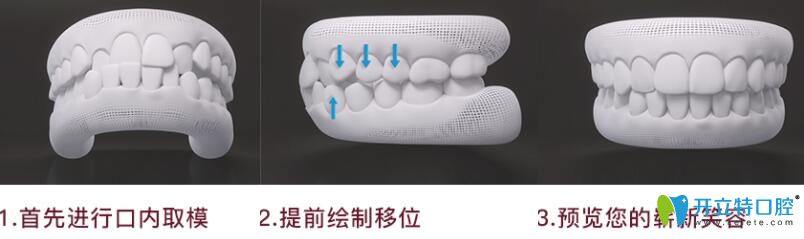 深圳珮斐齒科隱適美隱形矯正流程圖 深圳珮斐齒科隱適美隱形矯正流程圖