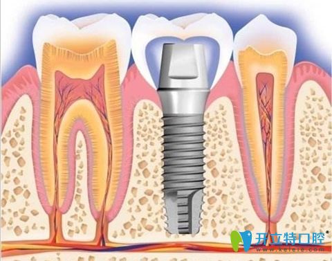 楊高非常擅長各類種植牙技術(shù)