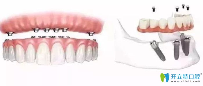 all—on—4半口種植牙價(jià)格