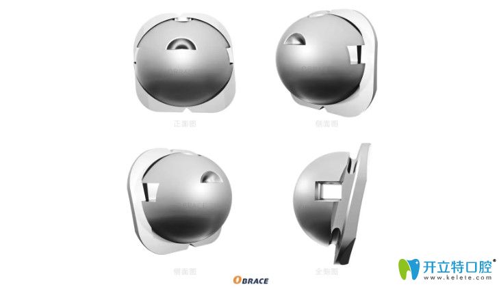 OBrace球面自鎖托槽矯正多少錢(qián)