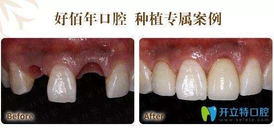 東莞好佰年口腔即刻種植牙對比圖