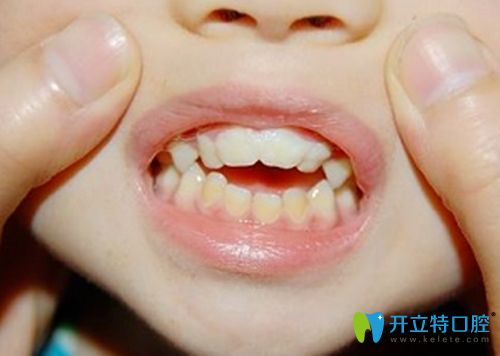 錯(cuò)位咬合圖 錯(cuò)位咬合圖