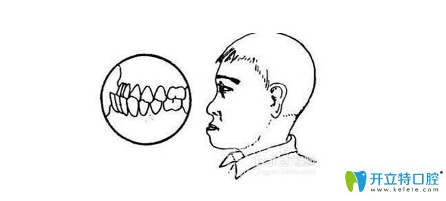 前牙反頜圖 前牙反頜圖