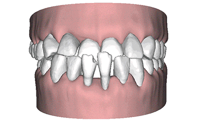 前牙深覆蓋動(dòng)畫圖解 前牙深覆蓋動(dòng)畫圖解