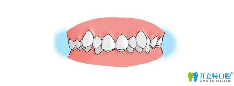 牙列擁擠圖 牙列擁擠圖