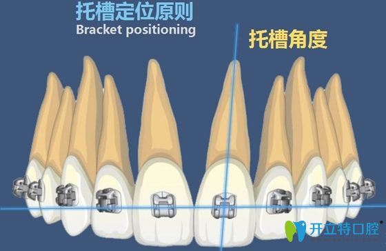 正畸時托槽定位原則示意圖
