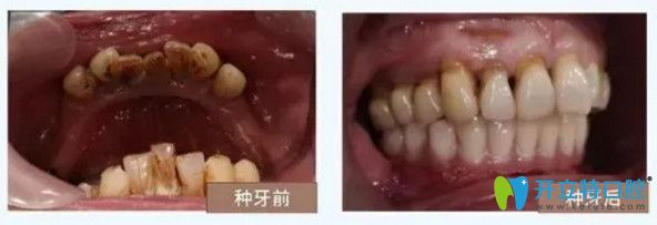 南寧柏樂(lè)口腔種植牙對(duì)比圖