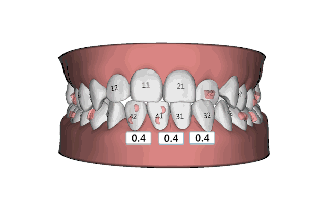 隱適美iTero口掃可預(yù)知矯正效果