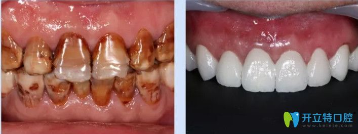 南寧柏樂口腔重度四環(huán)素牙全瓷冠修復(fù)對比圖