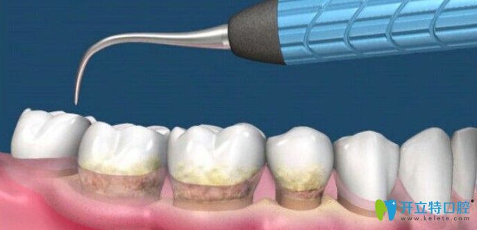 李懿來告訴大家為什么醫(yī)生不建議做齦下刮治？