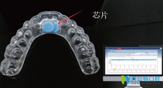 易而戴牙套芯片設(shè)計(jì)