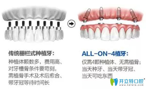 傳統(tǒng)種牙和一日得種牙的區(qū)別