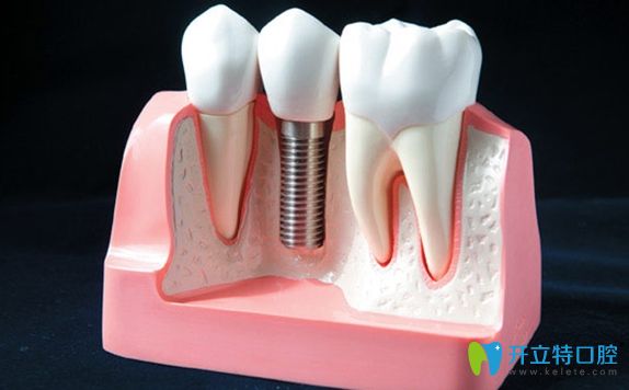 每個(gè)種植牙品牌都有自己的特色和優(yōu)勢(shì)