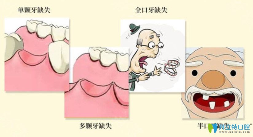 韓國(guó)sg與瑞士百丹特種植牙價(jià)格