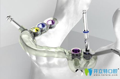 胡圖強講解什么是數(shù)字化種植牙 胡圖強講解什么是數(shù)字化種植牙