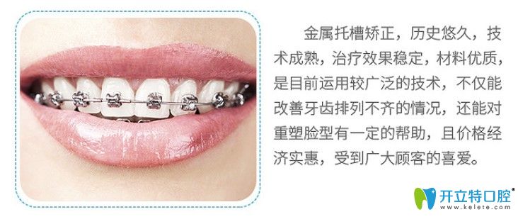 金屬自鎖托槽矯正優(yōu)勢