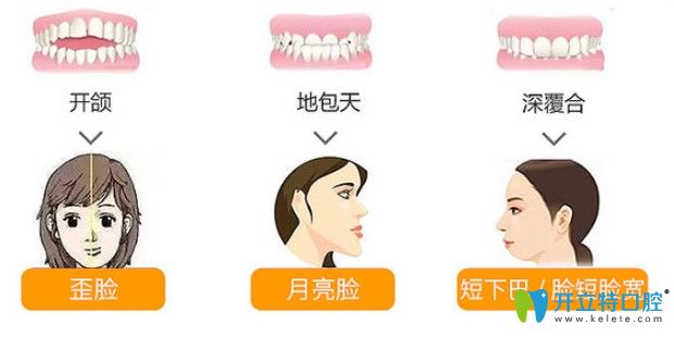 什么是陶瓷自鎖托槽矯正