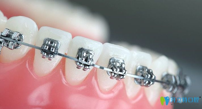 矯正后需要戴保持器鞏固