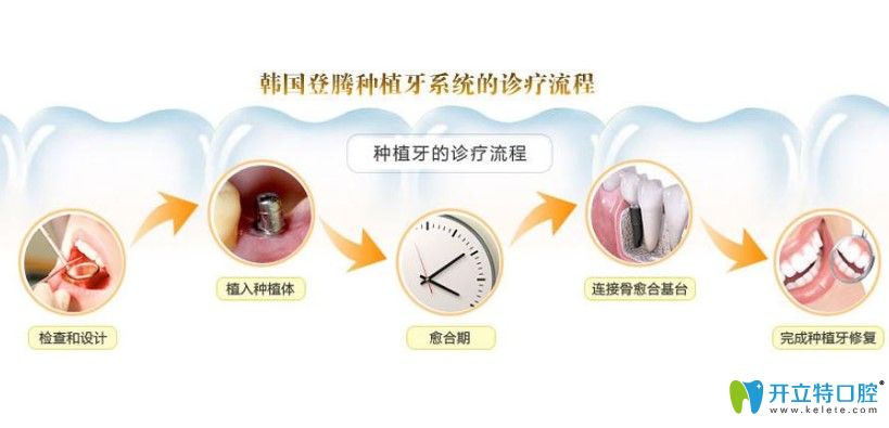 韓國登騰種植系統(tǒng)好不好