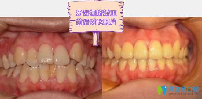 東營(yíng)鉑爾口腔牙齒擁擠矯正效果