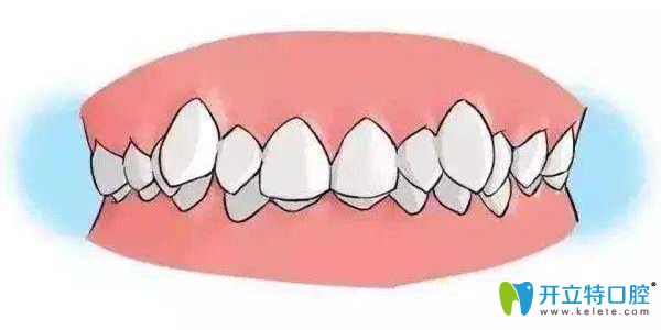 哪些情況需要做牙齒矯正