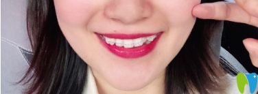 正在戴半隱形矯正時(shí)的圖片