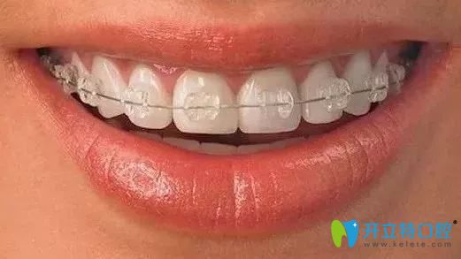 陶瓷托槽半隱形矯正圖