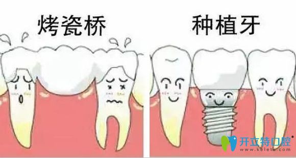 烤瓷牙和種植牙修復(fù)示意圖