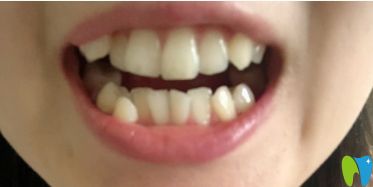 沒(méi)有進(jìn)行矯正前牙齒的樣子