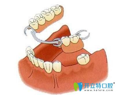 局部活動(dòng)義齒