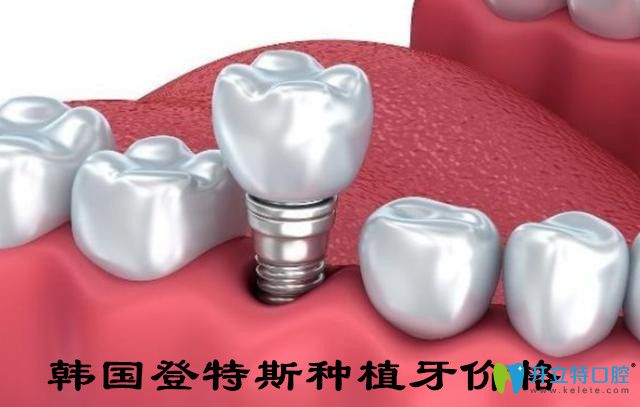 韓國(guó)登特斯種植牙價(jià)格