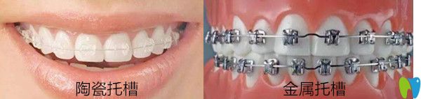 隱適美和金屬自鎖托槽區(qū)別,哪個好? 什么情況不能用隱適美