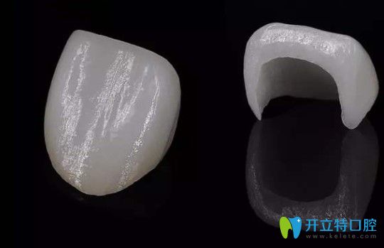 賈巖醫(yī)生解析全瓷牙貼面到底需要磨牙嗎