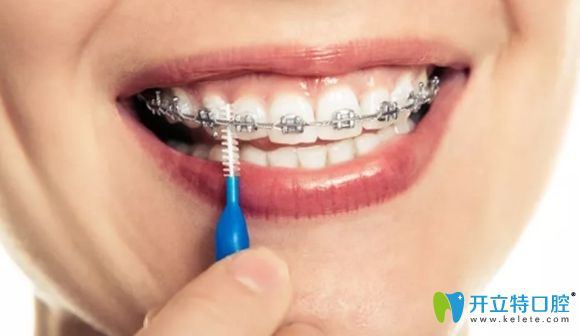 戴牙套期間怎么清潔口腔