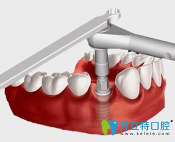 寧波恒美口腔王敬彬即刻負(fù)重種植牙好處 寧波恒美口腔王敬彬即刻負(fù)重種植牙好處