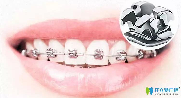 牙齒矯正過(guò)程中需要注意的地方