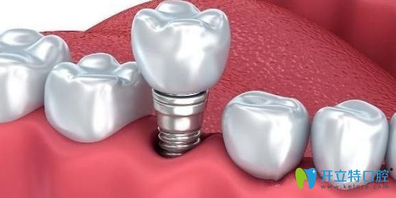 咸陽海濤口腔種植牙技術