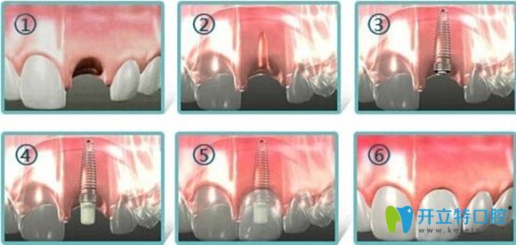 種植牙步驟圖解