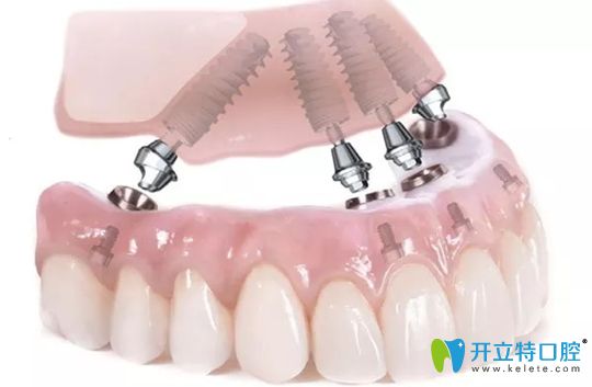 無(wú)錫北極星All-on-4半口種植技術(shù)