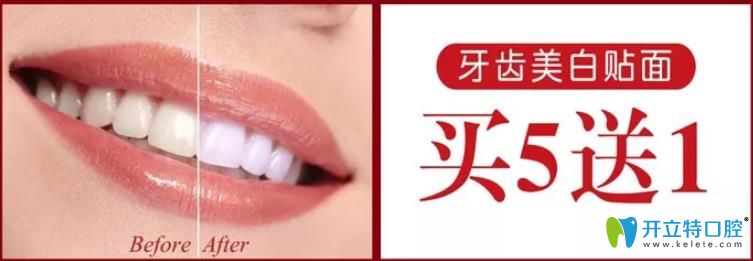 廈門登特口腔牙齒貼面活動