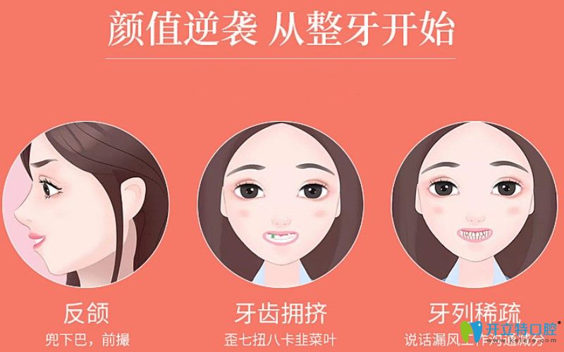 牙醫(yī)告訴你自鎖托槽有幾種牌子